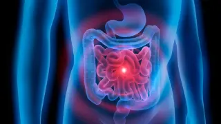 El cáncer de colon es el más diagnosticado en España.