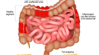 Enfermedad de Crohn. Intestino grueso y delgado humano con segmentos sanos e inflamación que afecta capas de la pared intestinal.