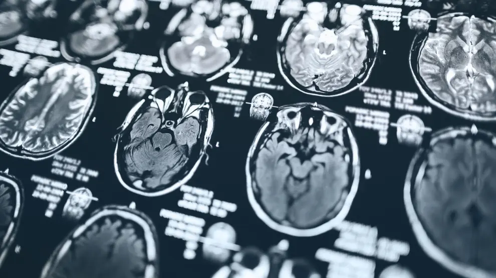 Encuentran un vínculo potencial entre el alzhéimer y el virus del herpes