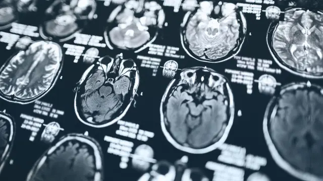 Imágenes de tejido cerebral tomadas mediante escáner.