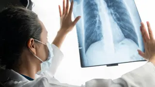 este tipo de cáncer ha tenido un gran aumento en mujeres jóvenes